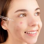 Best Skincare Products for Acne-Prone Skin in the USA (2026)